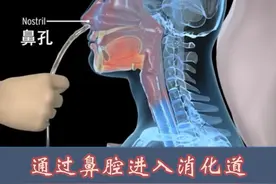 从鼻子走的胃镜检查，你做过吗？#鼻胃镜 #医学科普 #放松减压