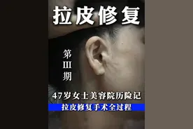 47岁女士美容院历险记（3） #拉皮 修复手术全过程#修复 #面部提升 #整形外科刘天一主任 #让我们一起变美视频封面