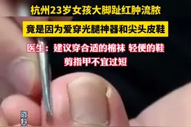 杭州23岁女孩爱穿#光腿神器 ，大脚趾红肿流脓…医生：建议穿合适的棉袜和轻便的鞋，剪指甲不宜过短。#甲沟炎 #健康 #丝袜 #压力袜视频封面