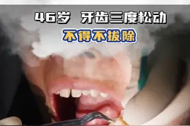 46岁 牙齿三度松动，不得不拔除！ 在自然牙列中,每个牙齿都存在一定的生理动度,一般不超过0.2mm。但如果出现牙周炎或咬合创伤,牙动度会明显增加。
牙齿松动3度是指牙齿松动幅度>2mm,或者牙齿唇(颊)舌向及近远中向松动,并伴有垂直向松动,表明牙齿松动的程度比较严重,一般建议直接拔除牙齿。#牙齿松动 #医学科普 #硬核健康科普行动视频封面