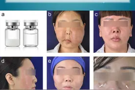 脸上打完生长因子4年后，还是复发了。 纳入这项研究的，共有32名女性，年龄在32-52岁区间。
其中比较典型是这几位：
第一位44岁女性，注射生长因子后3年出现严重的软组织增生；
第二位43岁女性，注射生长因子后1年出现弥漫性皮下肿胀和皮肤增厚；
第三位28岁女性，下巴注射生长因子后出现组织增生。
第四位47岁女性，在注射生长因子后，下巴出现组织增生和皮肤发红。
第五位42岁女性，在注射生长因子后8个月，泪沟区域有结节。视频封面