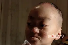 #男孩出生被诊断为蝴蝶宝贝  ，浑身伤痕却依旧心态阳光。妈妈：孩子寿命有限，想满足他的所有愿望，希望他开心过好每一天。#蝴蝶宝贝 （来源：@蝴蝶宝贝杨晨妈妈 ）