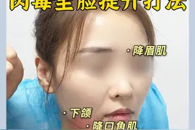 肉毒全脸提升打法，1分钟讲清楚 #肉毒素 #面部提升 #注射抗衰 #硬核健康科普行动  #关改新医生视频封面