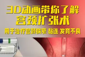 3D动画带你了解 宫颈扩张术#宫颈 #关爱女性健康 #医学科普