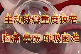 主动脉瓣重度狭窄，可能会出现呼吸困难 胸痛 晕厥 甚至猝死！ #在抖音pick你的健康搭子  #解锁春日健康清单  #抖出健康知识宝藏  #主动脉瓣重度狭窄 #内容启发搜索