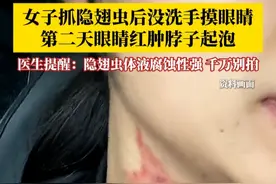 女子徒手抓隐翅虫后没洗手又摸眼睛，第二天眼睛红肿脖子起泡。医生：隐翅虫携带强酸性毒液，千万不要用手拍，遇到可轻轻吹走。#医生提醒遇到隐翅虫千万不要拍 #隐翅虫 #危险 #注意防范