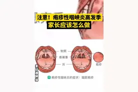 注意！疱疹性咽峡炎高发季，家长应该怎么做 #金牌育言家  #健康守护计划#育儿经验分享 #健康育儿 #育儿护理
