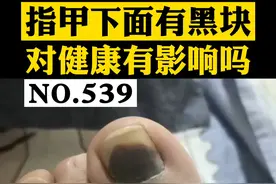 脚趾甲长了块黑印子，是身体健康出了问题吗？#科普 #指甲 #健康 