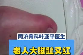 老人大脚趾有红又肿,跟上次骨折没关系,痛风发了! #医学科普 #大脚趾又红又肿 #脚趾肿痛 #痛风 #硬核健康科普行动