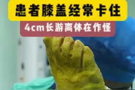 患者膝盖经常卡住，巨大的游离体在作怪 #手术顺利 #骨科 #膝关节 #硬核健康科普行动 #医疗健康创作训练营