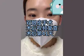 双眼皮术后恢复情况。 #双眼皮 #变美 #双眼皮术后恢复 #郑州双眼皮李朋杰 #妈生感视频封面