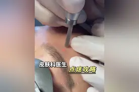 如何点痣不留坑/不留印，这份医生攻略请收好! #人表皮生长因子凝胶#科普#点痣#点痣后护理#激光点痣