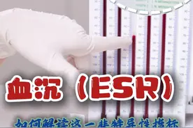 血沉（ESR）：如何解读这一非特异性指标 什么是血沉？
血沉，简单来说，就是红细胞在一定条件下沉降的速度。具体操作是将血液放在一个垂直的管子中，观察红细胞在一小时内沉降到管底的距离。这个距离以毫米/小时（mm/h）为单位表示。
血沉的重要性和应用
红细胞沉降率的检查对于疾病的诊断十分关键！它可以帮助医生：
判断疾病的活动性：比如风湿免疫性疾病、类风湿性关节炎等。
评估炎症的严重程度：特别是各种细菌感染、螺旋体感染等。
监测治疗效果：通过观察血沉的变化，了解治疗是否有效。
正常值范围
血沉的正常值会随着年龄和性别的不同而有所差异：
50岁以下的男性：一般低于15 mm/h。
50岁以下的女性：一般低于20 mm/h。
50岁以上的男性和女性：数值会有所上升，老年人的血沉测定值会随着年龄逐渐升高。
血沉升高的原因
1. 炎症性疾病
感染性疾病：如各种细菌感染、螺旋体感染等。
风湿免疫性疾病：如类风湿性关节炎、系统性红斑狼疮等胶原血管疾病，血沉往往会明显上升。
2. 其他因素
女性：通常比男性高。
贫血：贫血患者的血沉可能会增加。
终末期肾病或肾病综合征：这些患者的血沉也可能增加。
肥胖人群：肥胖可能导致血沉升高。
肿瘤相关炎症反应：血沉的升高可能与肿瘤性质、治疗效果和肿瘤活动性有关，但它是一个非特异性指标，不能单独用来诊断肿瘤。
综合判断的重要性
虽然血沉的检测非常重要，但也不能只看这一个指标就下结论哦！一定要结合其他检查结果和临床表现来综合判断。只有这样，我们才能更准确地了解自己的身体状况。
总结
血沉（ESR）作为一项重要的检验指标，能够帮助我们及早发现潜在的健康问题，特别是在炎症性疾病和风湿免疫性疾病方面。希望大家记住血沉的正常值范围，并理解其升高可能的原因。最重要的是，任何检查结果都需要结合其他检查和临床表现来综合判断，这样才能更全面地了解自己的健康状况。
#硬核健康科普行动  #血沉 #什么是血沉？ #血沉高说明什么 #医姐鸥姐