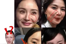 医美避坑项目大盘点！想变美不走弯路要注意以下四点 #避坑指南 #泪沟凹陷 #法令纹填充 #玻尿酸 #瘦脸针的副作用