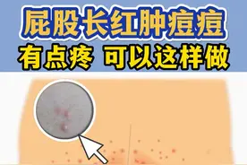 夏天屁股上长“痘”，红肿有脓头，可能是#毛囊炎 #可以这样做  #痘痘 #健康科普 #告别肌肤问题 #皮肤问题 
