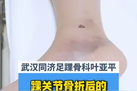 踝关节骨折后的皮肤状态和疼痛部位！ #踝关节骨折 #骨折 #踝关节扭伤 #抖出健康知识宝藏视频封面