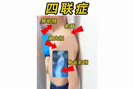 四联症 | 脖前倾 | 驼背 | 肩内扣 | 骨盆前倾 #脖子前倾 #耸肩驼背 #肩膀内扣 #骨盆前倾 #抖出健康知识宝藏