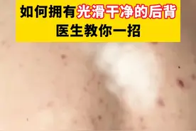 前胸后背长很痒的小疙瘩，别再挠了，这可能是#马拉色菌毛囊炎 ，要对症处理。#前胸后背痘#毛囊炎#痒#痘痘视频封面