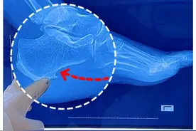 足底长了个骨刺 怎么办？ #足底骨刺 #跟痛症 #骨刺 #硬核健康科普行动视频封面