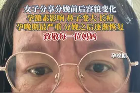 女子分享分娩前后容貌变化，鼻子变大，长痘！致敬每一位妈妈。#孕激素#当妈妈后的真实感受#妈妈辛苦了#分娩