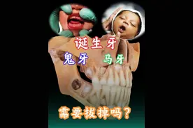 出生自带的“鬼牙”、“马牙”是什么？要拔掉吗？ 诞生牙