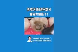 清理牙齿龋坏部分，看完太解压了！#保护牙齿 #牙齿清洁 #解压 #牙医日常 #华西口腔 视频封面