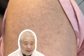 手臂、大腿上这些麻麻赖赖，皮肤科医生教你解决#鸡皮肤 #硬核健康科普行动  #入冬换季不患疾  #医学科普 #皮肤干燥