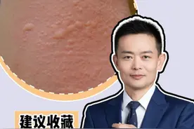 腿上长了荨麻疹，患者误认为是痘痘！ #荨麻疹 #医学科普 #皮肤病 #涨知识 #门诊记录