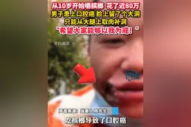 从十岁就开始嚼槟榔！#男子罹患口腔癌从大腿取肉补洞  隔着屏幕都感觉疼。#槟榔的危害 #口腔癌