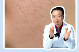 长痘痘留下的坑坑洼洼为什么要做点阵激光？#皮肤科医生谢红付 #点阵视频封面