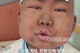 9岁男孩豪豪开始新一轮化疗，“打怪兽第二天，一天光吐。”#坚强的小男孩儿 #豪豪 #愿宝宝早点好起来 #勇敢的宝宝