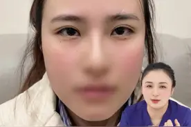 微创双眼皮6.5mm平扇案例讲解 #抖出健康知识宝藏 #医疗健康创作训练营 #苏州双眼皮 #苏州市立秦丹莹 #苏州秦丹莹双眼皮