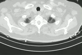 老年男性，畏寒发热气促1天，发现IGA肾病3月，口服强的松60mg/天