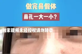 做完鼻假体 鼻孔一大一小？#河南dou知道视频封面