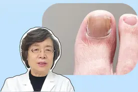 #灰指甲 总是反复治不好？医生一条视频教你怎么去根！#医学科普 #灰指甲用什么药 #健康 #灰指甲初期的照片