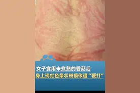 3月2日（报道）湖北襄阳一女子吃了未煮熟的香菇，发现小腿两侧突然出现许多红色条状斑痕，像被“鞭打”过一样，且瘙痒难耐！医生：香菇皮炎，香菇必须熟透了再吃！