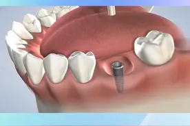 牙槽骨萎缩了怎么种牙？植骨了解一下吧#种植牙 #科普