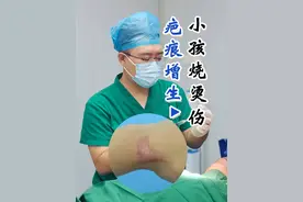 小孩手腕烧烫伤疤痕增生 #疤痕增生怎么祛 #烧烫伤疤痕 #疤痕修复 #疤痕体质 #太原疤痕疙瘩