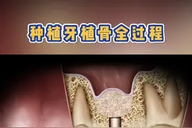种植牙植骨全过程~ #种植牙 就像种树一样，要保证坑里有足够的土壤，否则就无法种植成功。所以就需要植骨，植骨分为：自体骨和异体骨（骨粉），较为常用吸收较好的是自体骨。#种牙