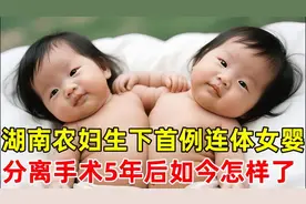 农妇生下湖南首例连体双胞胎,分离手术5年后如今怎样了 ？？视频封面
