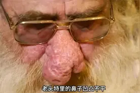 老头鼻子长出巨大的赘物，严重到影响呼吸，挤压黑头分泌大量油脂