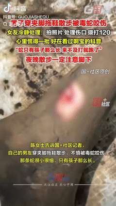 你遇到过被蛇咬的惊险事吗