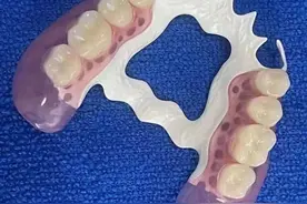 拔牙后多久才能装假牙?# 这是许多患者关心的问题图片