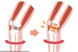 阴雨天为什么膝盖会疼 阴雨天膝盖疼痛的原因有多种图片