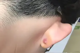 郑州一女子孕后耳洞增生，几乎和耳朵一样大？图片