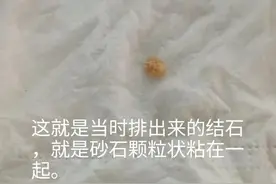 肾结石，自行排出真的可行吗？图片