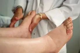 脚肿比脸肿更麻烦 脸肿，大部分都是胸积水，或者肺有积水...图片