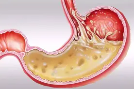 95岁国医大师张磊分型论治反流性食管炎：肝胃不和图片