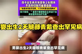 男婴出生2天腿部青紫查出罕见病