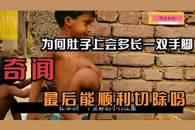 小男孩肚子上多长出一双手脚，不但痛苦还被嫌弃，最后会被治好吗视频封面